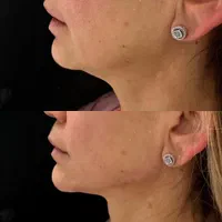 فیلر بادی/کانتورینگ صورت/تزریق چربی/بوتاکس/ژل لب|خدمات آرایشگری و زیبایی|تهران, تهرانپارس غربی|دیوار