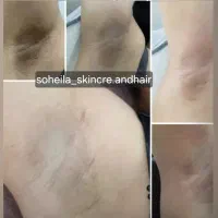 تخفیف ویژه رفع تیرگی بدن بادستگاه کیوسوییچ|خدمات آرایشگری و زیبایی|کرج, چهارصد دستگاه|دیوار