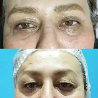 بلفاروپلاستی پلک بالا به مدت محدود فقط 8 میلیون|خدمات آرایشگری و زیبایی|بوکان, |دیوار