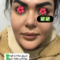 تزریق تخصصی ژل بوتاکس