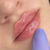 تزریق ژل لبm زاویه سازی لیزر390 بوتاکس تضمینی