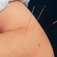 درمان بیماریها با طب سوزنی