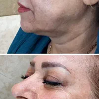 لیپوساکشن شکم و پهلو،ترنسفر به باسن،هایفودابلوگولد|خدمات آرایشگری و زیبایی|اصفهان, دشتستان|دیوار