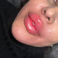 تزریق بوتاکس و ژل در محل