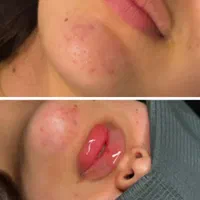 تخفیف لیزر و تزریقات ژل ، بوتاکس و مزو|خدمات آرایشگری و زیبایی|تهران, مهران (سیدخندان)|دیوار