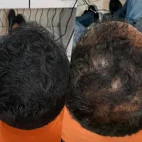 جشنواره تزریق ژل بوتاکس پی آر پی توسط پزشک|خدمات آرایشگری و زیبایی|کرمانشاه, |دیوار