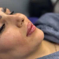 تزریق ژل و بوتاکس