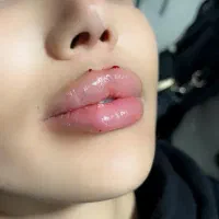 تزریق آموزش ژل بوتاکس چربی|خدمات آرایشگری و زیبایی|صدرا-فارس, فاز ۱|دیوار