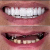 شرایط ویژه جشنواره دندانپزشکی ایمپلنت و اوردنچر|خدمات آرایشگری و زیبایی|آذرشهر, |دیوار