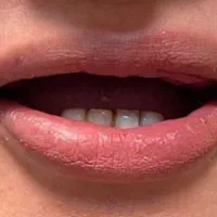 دندان مصنوعی (پروتز)