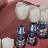 ایمپلنت مادام العمر