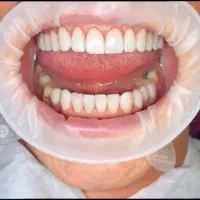 .تخفیف ویژه دندان پزشکی .کامپوزیت.وتمام خدامات|خدمات آرایشگری و زیبایی|اردبیل, |دیوار