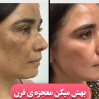 لیزر موهای زائدروشن کننده ورفع لک رفع منافذبوتاکس|خدمات آرایشگری و زیبایی|رشت, بوسار|دیوار