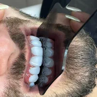 دندانپزشکی.کامپوزیت دندان .عصب کشی .لمینت.روکش|خدمات آرایشگری و زیبایی|تهران, تهرانپارس شرقی|دیوار
