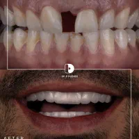 کامپوزیت دندان/لمینیت/دندانپزشکی|خدمات آرایشگری و زیبایی|مشهد, کوثر|دیوار