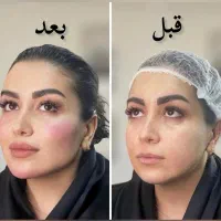 ساکشن غبغب و کانتورینگ صورت