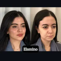 تزریق ژل بوتاکس فیلر در کلینیک زیبایی تهران