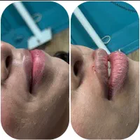 پذیرش مدل فیلر توسط پزشک