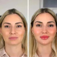جشنواره تخفیف ۵۰ درصدی ژل بوتاکس‌ فیلربادی