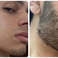 رویش مجدد ریش سبیل مو