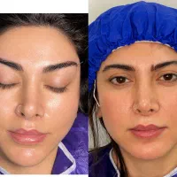 جراحی لیفت شقیقه دایرکت ابرو و تحتانی بخیه لیزری|خدمات زیبایی و سلامت|تهران, ایوانک|دیوار