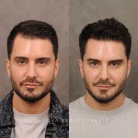 پی آر پی *بدون‌درد* prp قطع ریزش مو با ضمانت  365ت|خدمات آرایشگری و زیبایی|تبریز, |دیوار