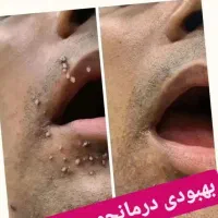 درمان زگیل خانم ها