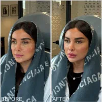 ژل لب روسی مادلینگ عربی زاویه سازی بوتاکس بادی|خدمات آرایشگری و زیبایی|تهران, سعادت‌آباد|دیوار