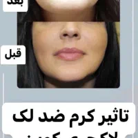 نمایندگی پخش کرم ضدلک لاکچری کوین(کرم۸کاره) اصلی|آرایشی، بهداشتی، درمانی|کرج, گوهردشت|دیوار