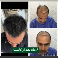 کاشت مو روش سوپر FUE پلاس(روش شیرازی)فقط ۱۵ میلیون|خدمات آرایشگری و زیبایی|یزد, |دیوار