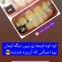 راهنمایی درباره محصول سفید کننده دندان|فعالیت داوطلبانه|مشهد, شهرک بهارستان|دیوار