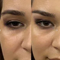 تخفیف بلفاروپلاستی،بوکال فت،ساکشن غبغب،سانترال لب