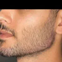 جشنواره تزریق ژل و بوتاکس و لیفت نخ و مزو چربی سوز|خدمات آرایشگری و زیبایی|کرمانشاه, |دیوار
