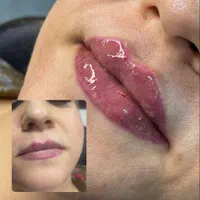 ژل لب تزریق ژل بوتاکس ژل گونه چانه زاویه فک|خدمات آرایشگری و زیبایی|اصفهان, سعادت‌آباد|دیوار