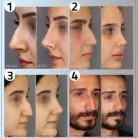 جشنواره جوانسازیMax Lift پزشک پوست مو ژل بینی ابرو|خدمات زیبایی و سلامت|مشهد, هفت تیر (حافظ)|دیوار