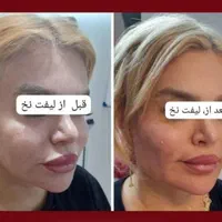 لیفت نخ انزیم ژل وبوتاکس پلاسما تتوبدن فشیال...|خدمات آرایشگری و زیبایی|قم, باجک دو|دیوار