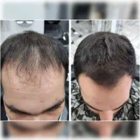 برای اولین بار در ایران بدون کاشت موهاتو پرپشت کن