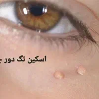 برداشتن خال زگیل میخچه باقیمت فوق العاده توسط پزشک|خدمات آرایشگری و زیبایی|اسلام‌شهر, |دیوار