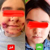 درمان وبدون برگشت بیماری های پیسی وپسوریازیس|خدمات آرایشگری و زیبایی|قم, آرامستان بهشت معصومه|دیوار
