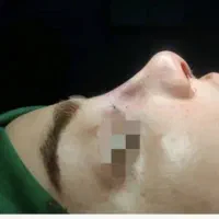 عمل بینی با ضمانت نامه کتبی کیفیت