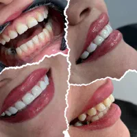 کامپوزیت دندان با برندهای معتبر جهانی|خدمات آرایشگری و زیبایی|اهواز, نادری|دیوار