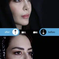 عمل بینی با قالبهای کنترلی|خدمات آرایشگری و زیبایی|تهران, امانیه|دیوار