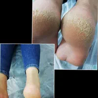 ازبین بردن تیرگی ،ازبین بردن ترک عمیق پا