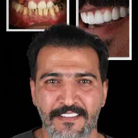 ایمپلنت اقساطی با قیمت ۱۲۸۰۰/تخفیف تکرارنشدنی
