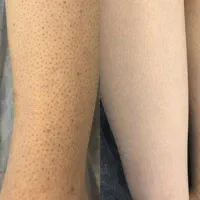 لیزر موهای زائد با 40 درصد تخفیف کل بدن فقط 400