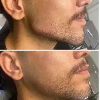 ژل لب فیلر بوتاکس پی ار پی فیلر گونه خط خنده