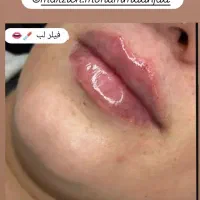 فیلر وبوتاکس|خدمات آرایشگری و زیبایی|گرگان, |دیوار