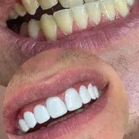 جشنواره کامپوزیت دندان|خدمات آرایشگری و زیبایی|شاهرود, |دیوار