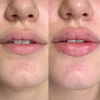 جشنواره آموزشی فیلر نخ بوتاکس زیر نظر دکتر...|خدمات آموزشی|تهران, قلهک|دیوار