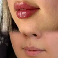 ژل لب، فیلر صورت، بوتاکس|خدمات آرایشگری و زیبایی|نجفآباد, امام خمینی|دیوار